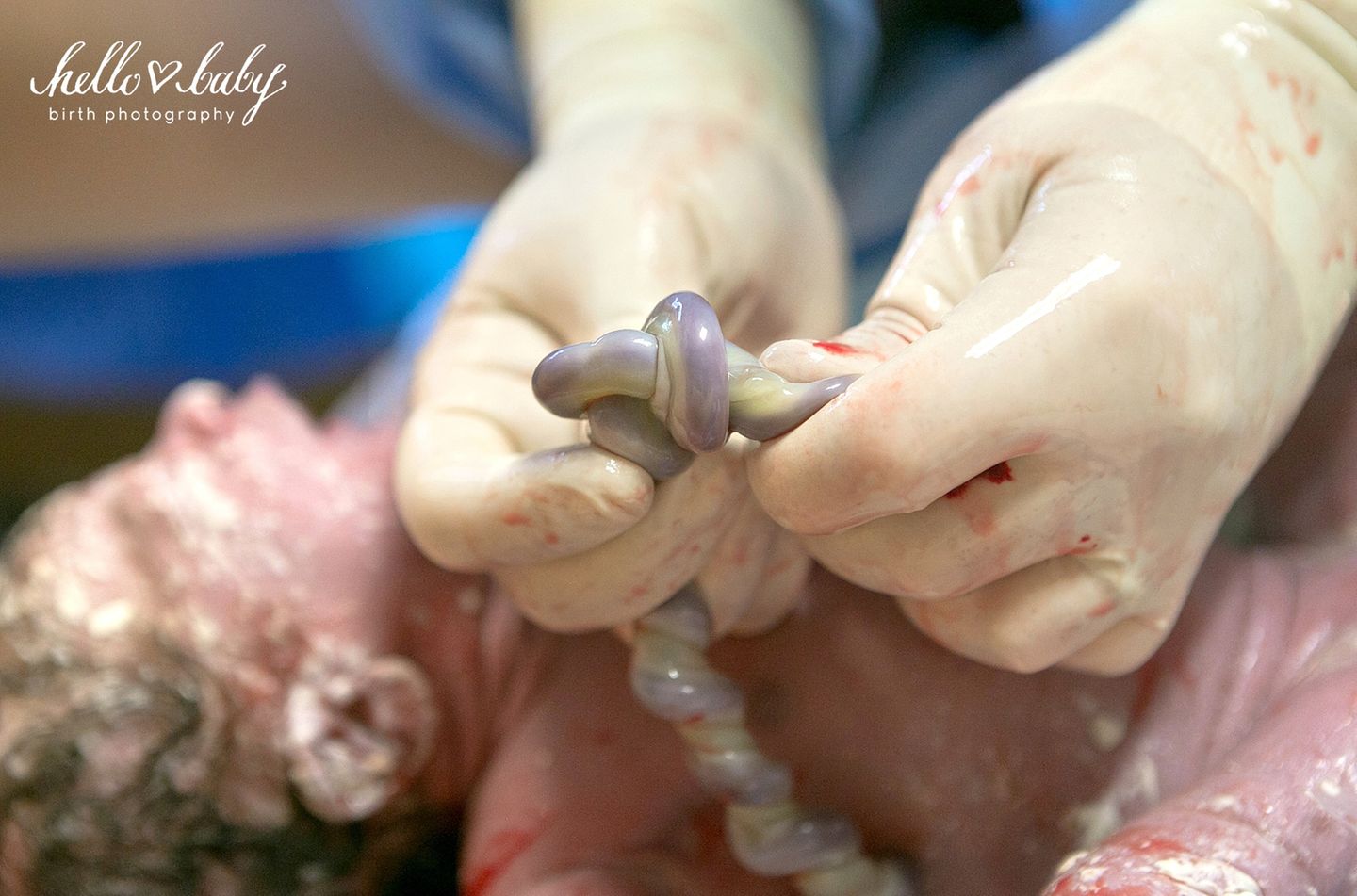 Emotionen pur!: "Ein echter Knoten in der Nabelschnur kommt im Mutterleib sehr selten vor. Normalerweise macht sie keine Probleme, aber sie kann sich zuziehen, wenn das Baby durch den Geburtskanal gepresst wird. Das kann die Blutzirkulation zwischen Plazenta und Kind unterbrechen."
