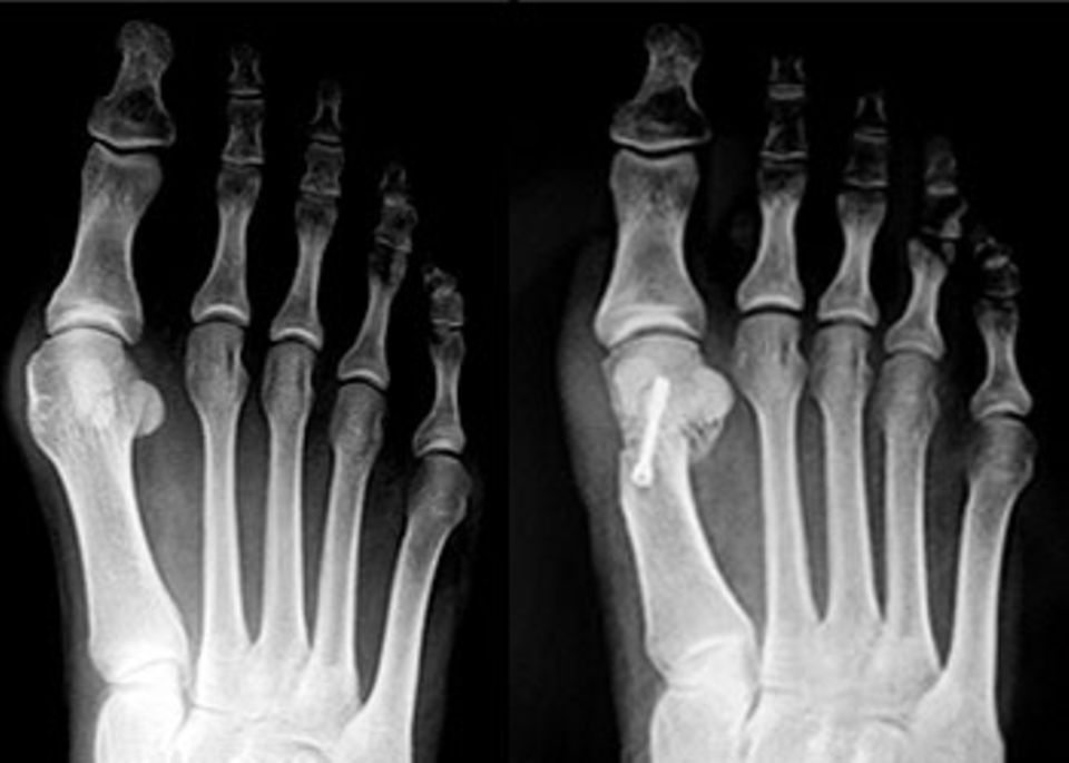 Das linke Bild zeigt einen mittelschweren Ballenzeh und leichten Spreizfuß - typisch für eine 30- bis 35-Jährige, die beginnende Schmerzen an der Fußinnenseite hat. Mit der Chevron-Austin-Operation wurde der Knochen V-förmig durchtrennt, verschoben und mit einer Titanschraube fixiert.