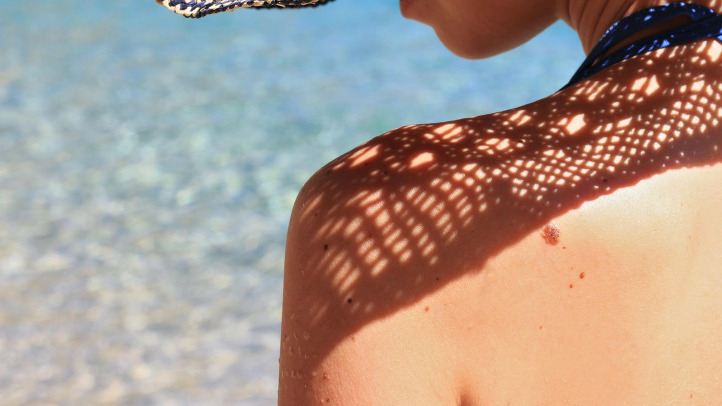 SonnenbrandTattoos Gefährlicher Sommertrend BRIGITTE.de