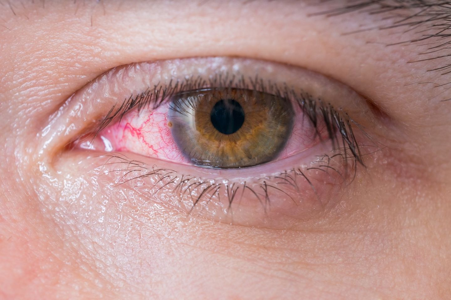 Nicht zu unterschätzen: Das müsst ihr jetzt über die Augengrippe wissen!