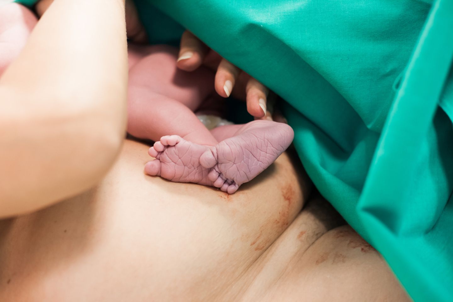 Schock beim Kaiserschnitt: Wo ist das Baby!?