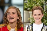 Emma Watson mit alten und neuen Zähnen