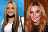 Lindsay Lohan mit Zähnen im Vorher/Nachher-Vergleich