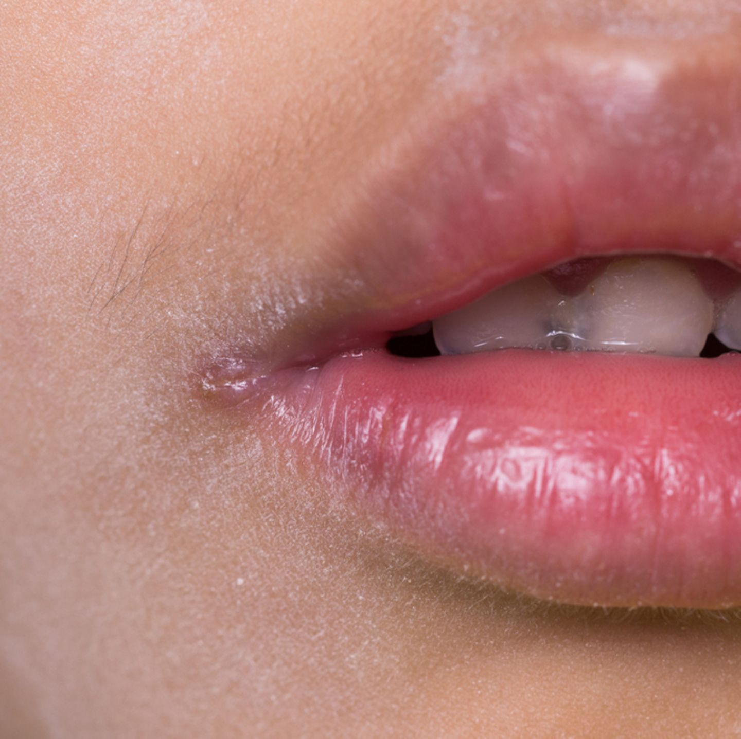 Lippe eingerissene Dermatologie: Was