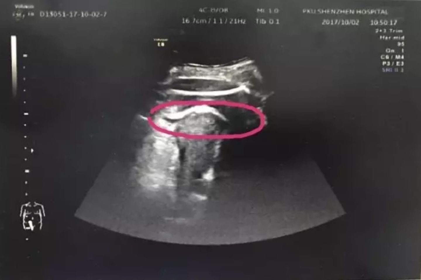 Ein Ultraschallbild zeigt die Stelle, an der das Baby ein Loch in die Gebärmutter der Mutter trat.