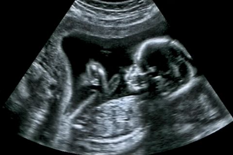 Ein Ultraschallbild zeigt ein ungeborenes Kind.