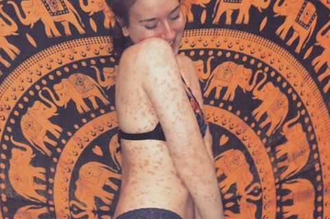 Instagram: Eine Frau mit Schuppenflechte posiert in Unterwäsche