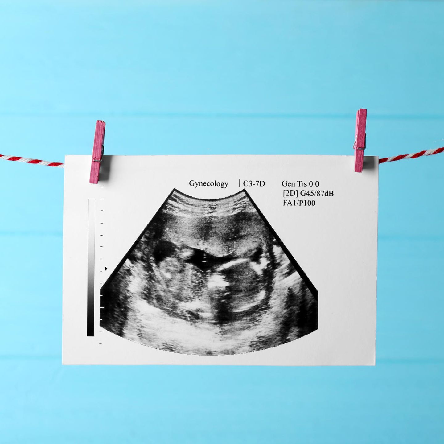 Ultraschallbild vor türkiser Wand an Mini-Wäscheleine aufgehängt
