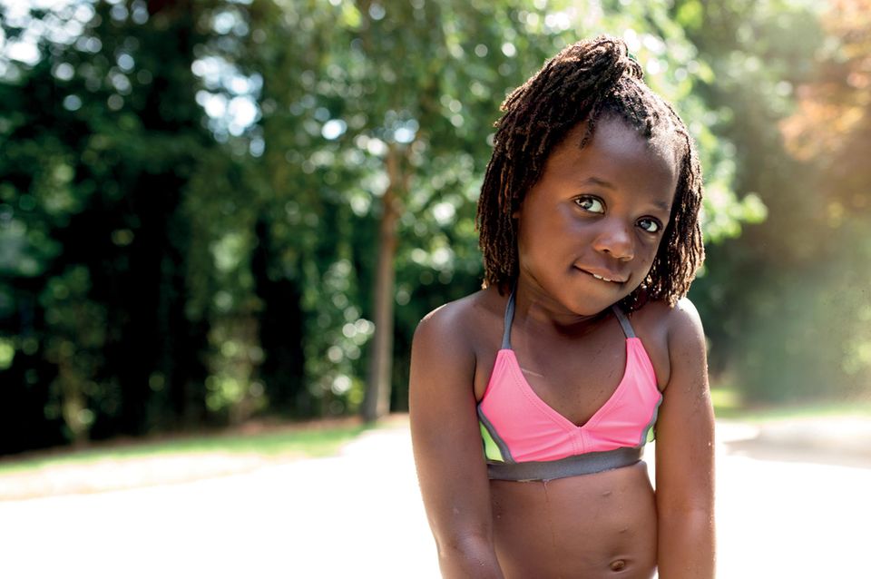 Emmy, 6, zeigt ihre Narben Emmy, 6, zeigt ihre Narben