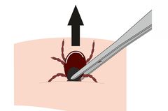 Was tun bei Zeckenbiss? Zecke entfernen mit Pinzette Was tun bei Zeckenbiss? Grafik Zecke entfernen mit Pinzette