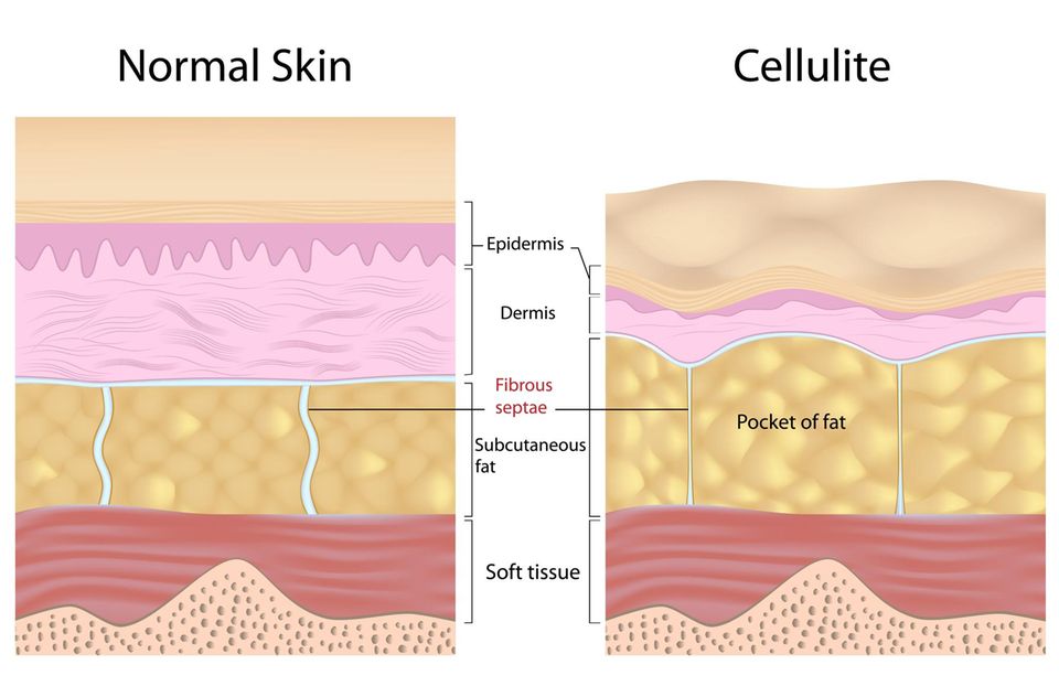 Bindegewebsschwäche: Grafik Cellulite