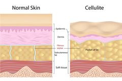Bindegewebsschwäche-Grafik Bindegewebsschwäche: Grafik Cellulite