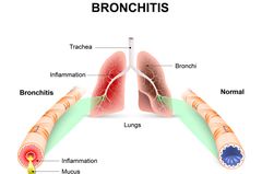Starker Husten: Woher er kommt und was hilft Grafik Starker Husten: Grafik einer Bronchitis