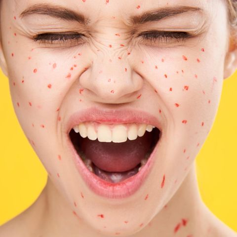Zink gegen Akne: Frau mit Pickeln im Gesicht
