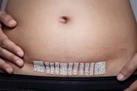 Langzeitfolgen vom Kaiserschnitt: Frauenbauch mit Kaiserschnitt-Narbe