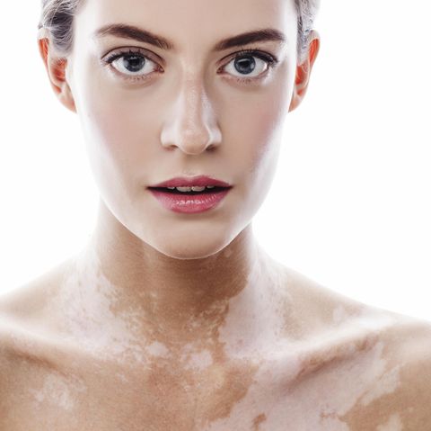 Vitiligo: Frau mit Weißfleckenkrankheit (Vitiligo) am Hals und De­kolle­té