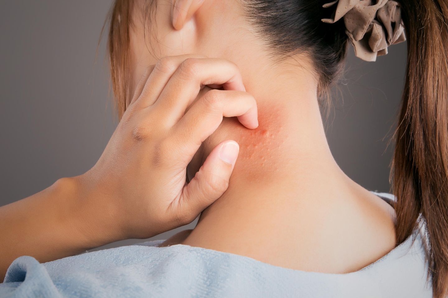 Mückenstich-Allergie: Frau mit Mückenstich am Nacken