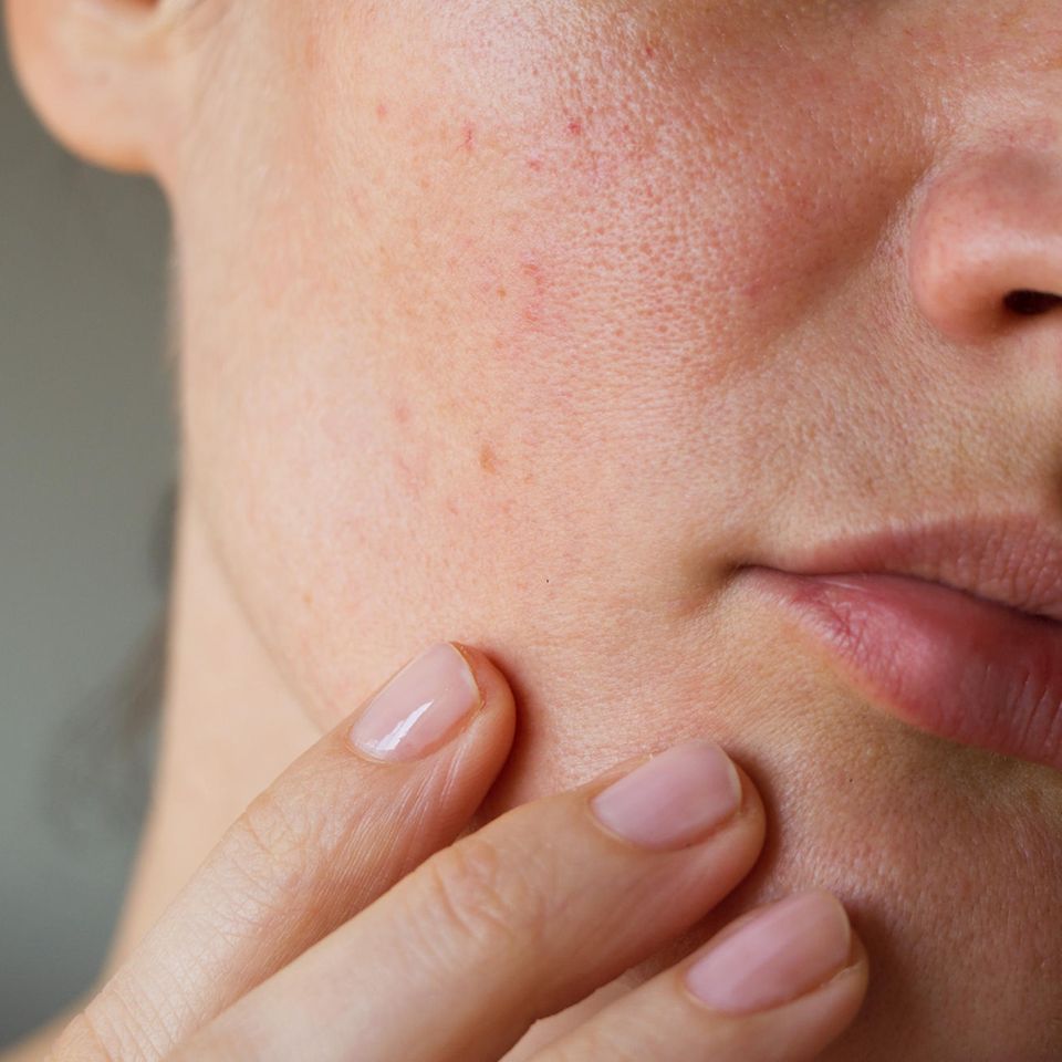 SOS-Tipps für zickige Haut: Unreine Haut