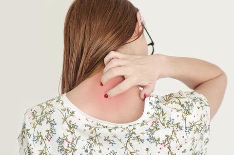 Hautausschlag: Frau mit Ausschlag am Nacken