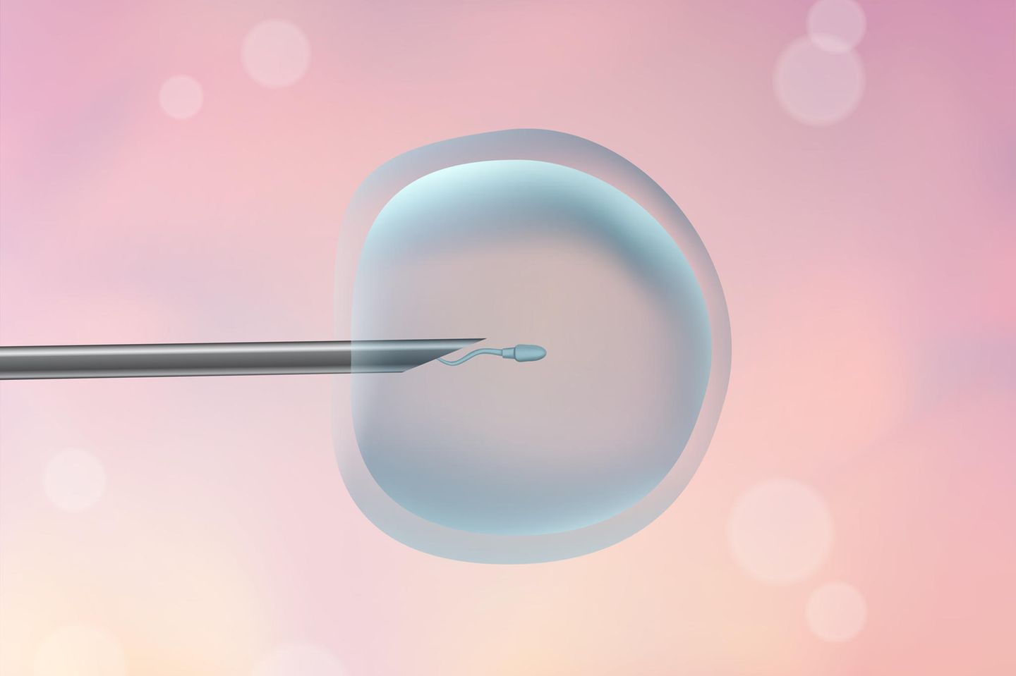 ICSI: Nadel mit Spermium in Eizelle