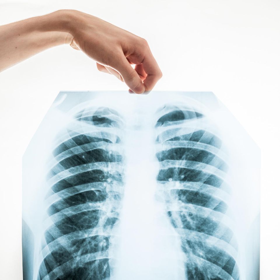 Lungenkrebs behandeln: Röntgenbild einer Lunge