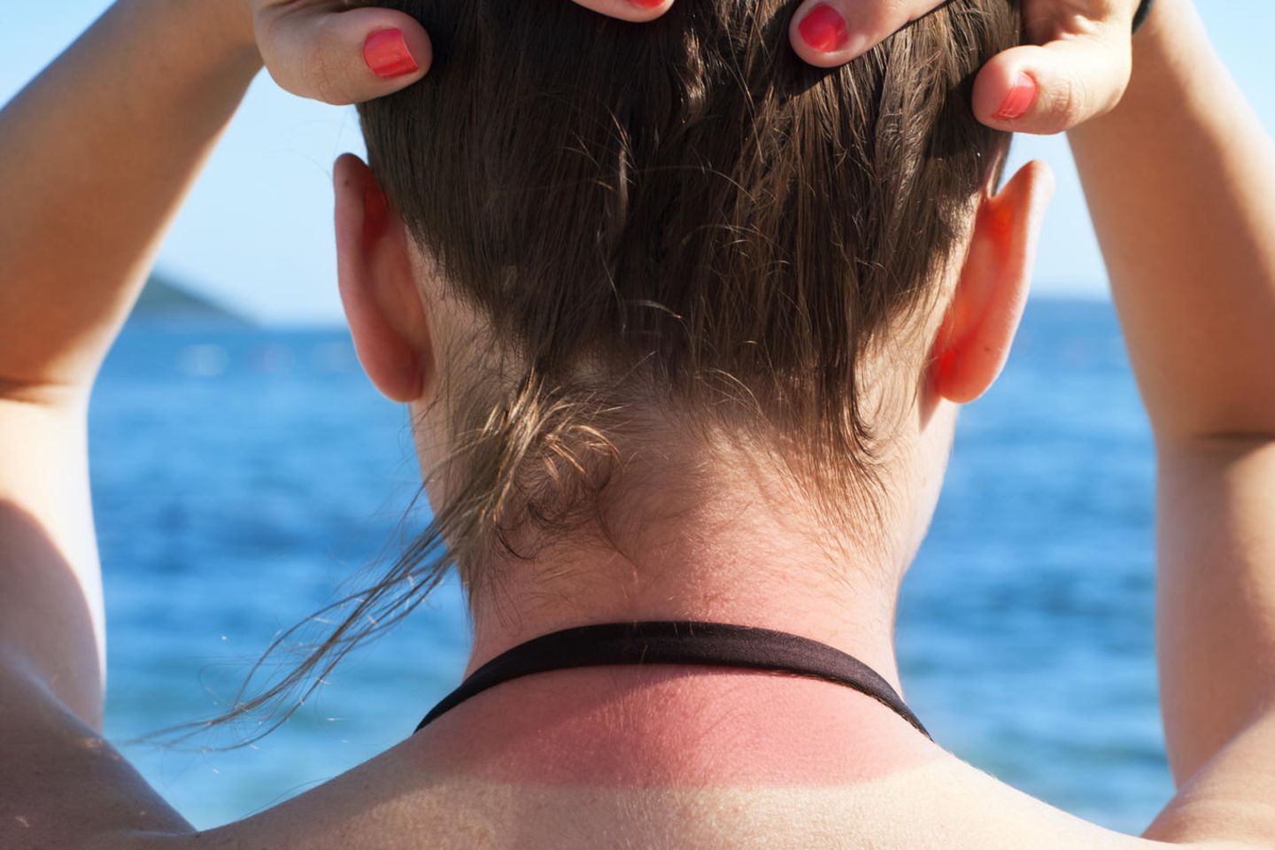Sonnenbrand: Frau mit Sonnenbrand auf dem Nacken