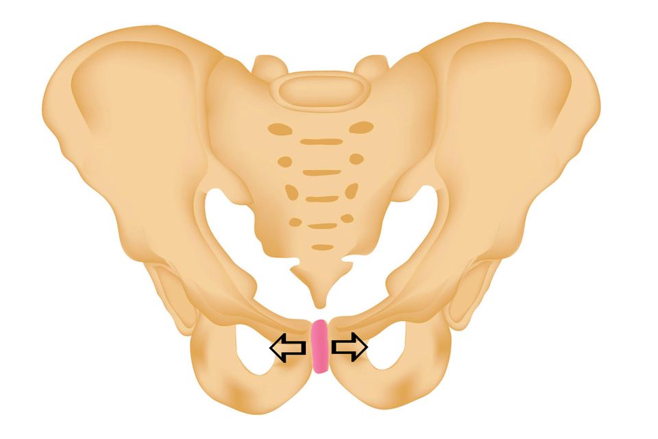 Symphysenlockerung