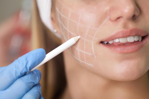 Beauty-OP-Trend: Chirurg zeichnet Linien auf Gesicht einer Frau