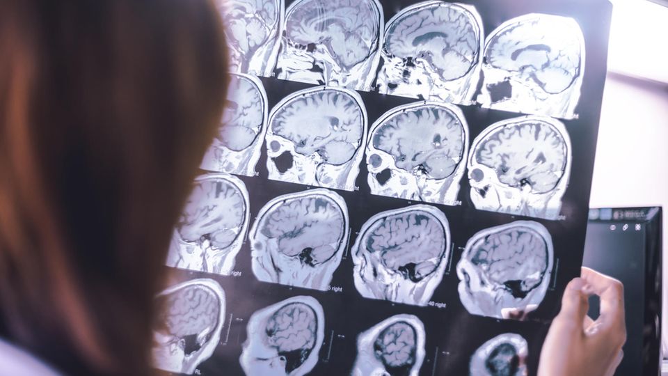 So kann man laut der WHO Demenz vorbeugen So kann man laut der WHO Demenz vorbeugen