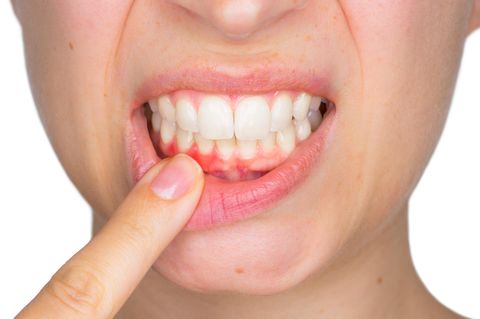 Hausmittel gegen Zahnfleischentzündung: Frau zeigt wundes Zahnfleisch
