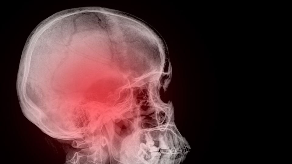 Häufige Handynutzung: So sehr verändert sich Dein Schädelknochen
