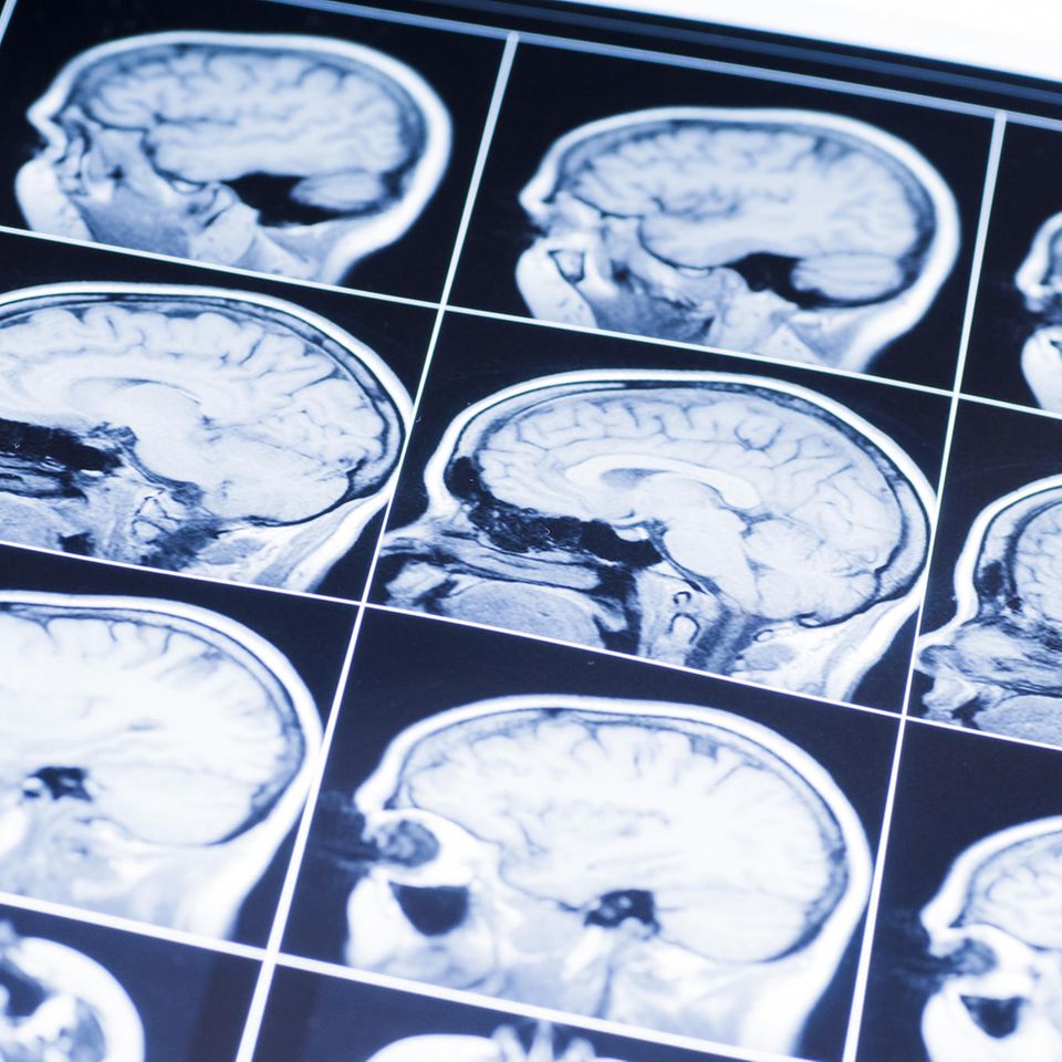 Serotonin erhöhen: Röntgenbilder vom Gehirn