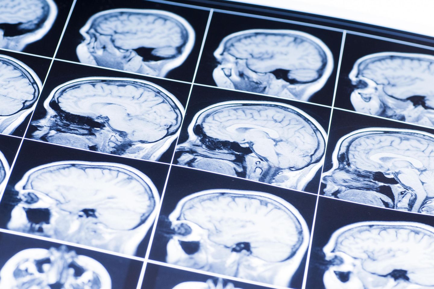 Serotonin erhöhen: Röntgenbilder vom Gehirn