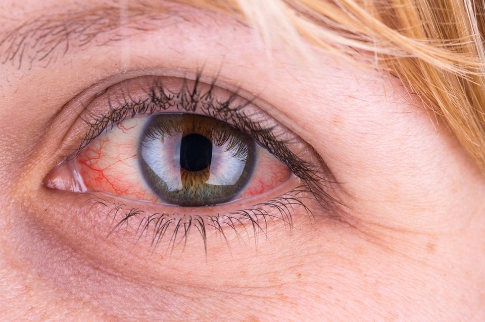 Rote Augen: Frau mit rotem Auge