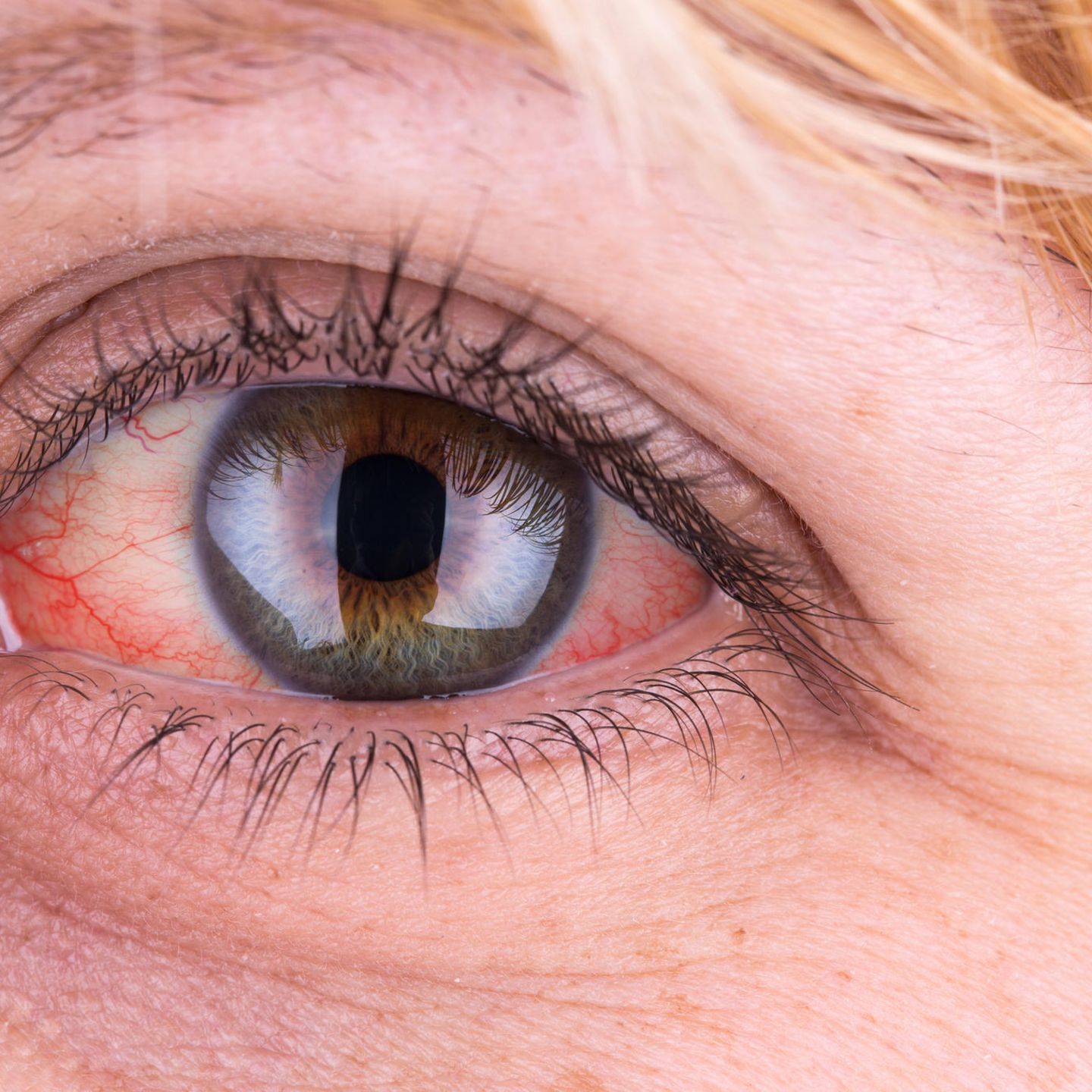 Rote Augen Ursachen Und Behandlung Brigitte De