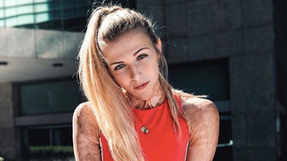 Brandopfer: Wie die tapfere Julie zur Influencerin wurde