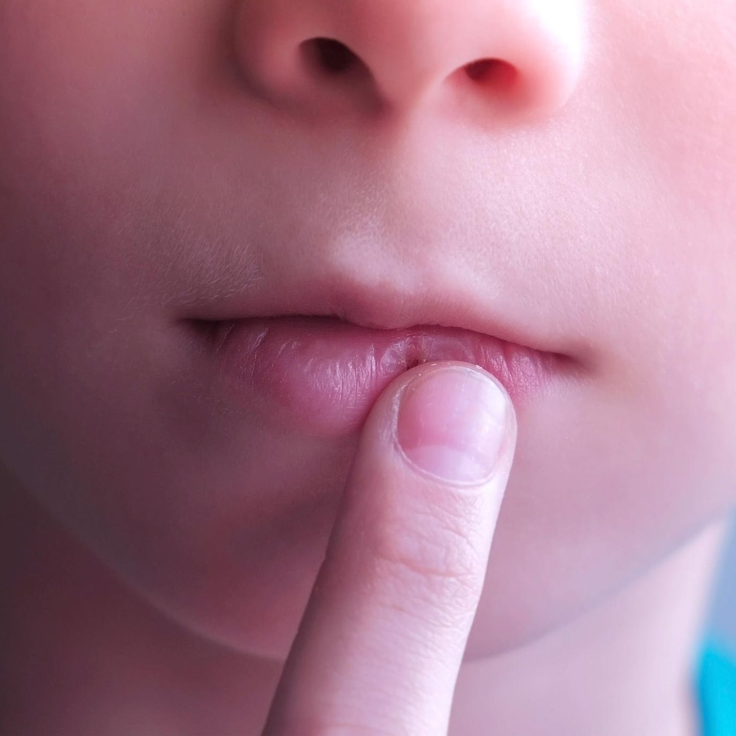 Herpes wovon kommt Lippenherpes: Ursachen