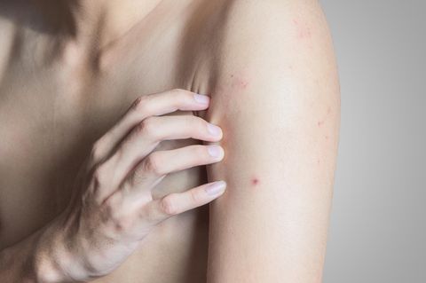 Rote Punkte auf der Haut: Nackter Oberkörper, eine Hand fasst an den mit roten Punkten übersäten Arm