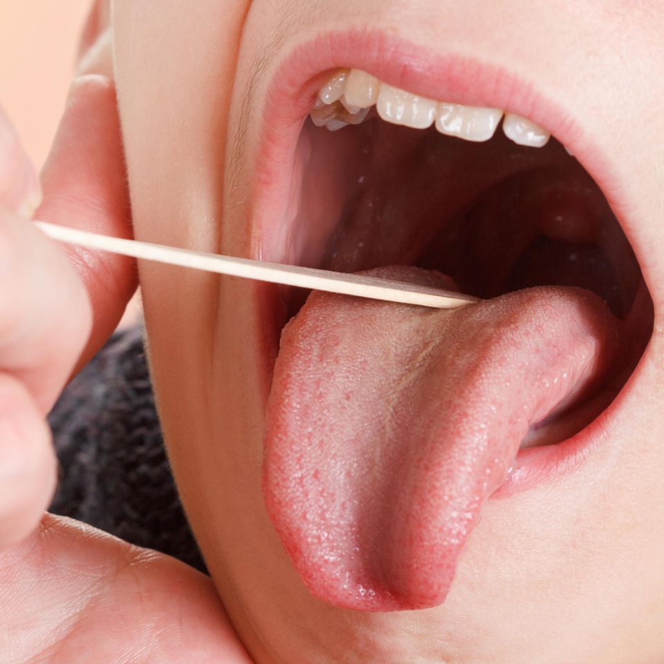 Geschwollene Zunge: Holzplättchen auf Zunge