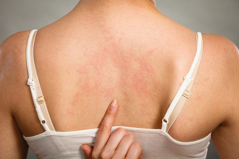 Hausmittel gegen Nesselsucht: Frau mit Hautirritationen am Rücken