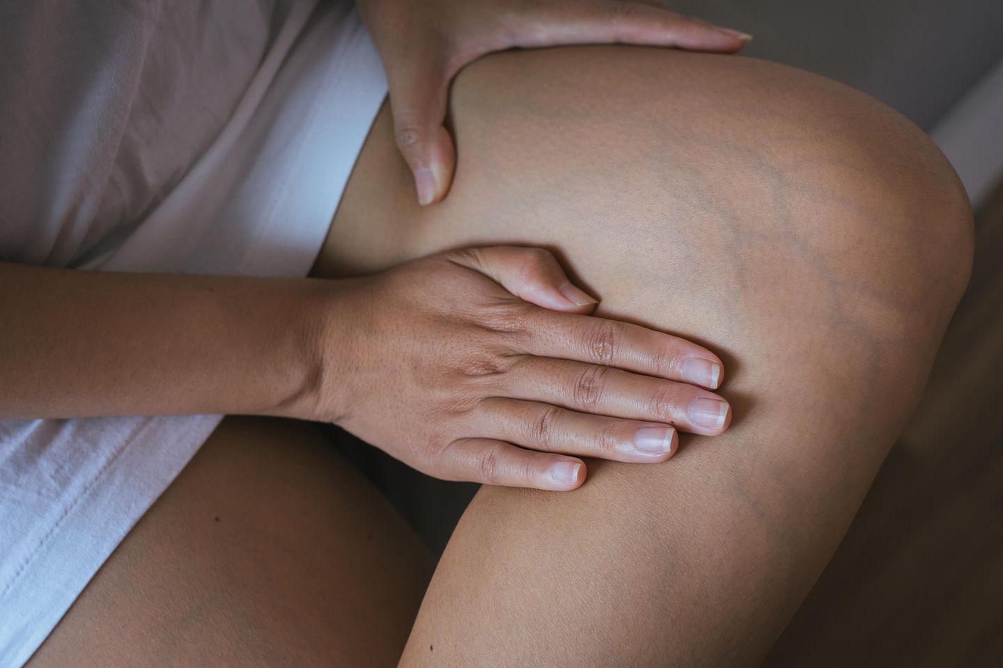 Hausmittel bei Venenentzündung: Frau fasst sich an Krampfadern am Bein