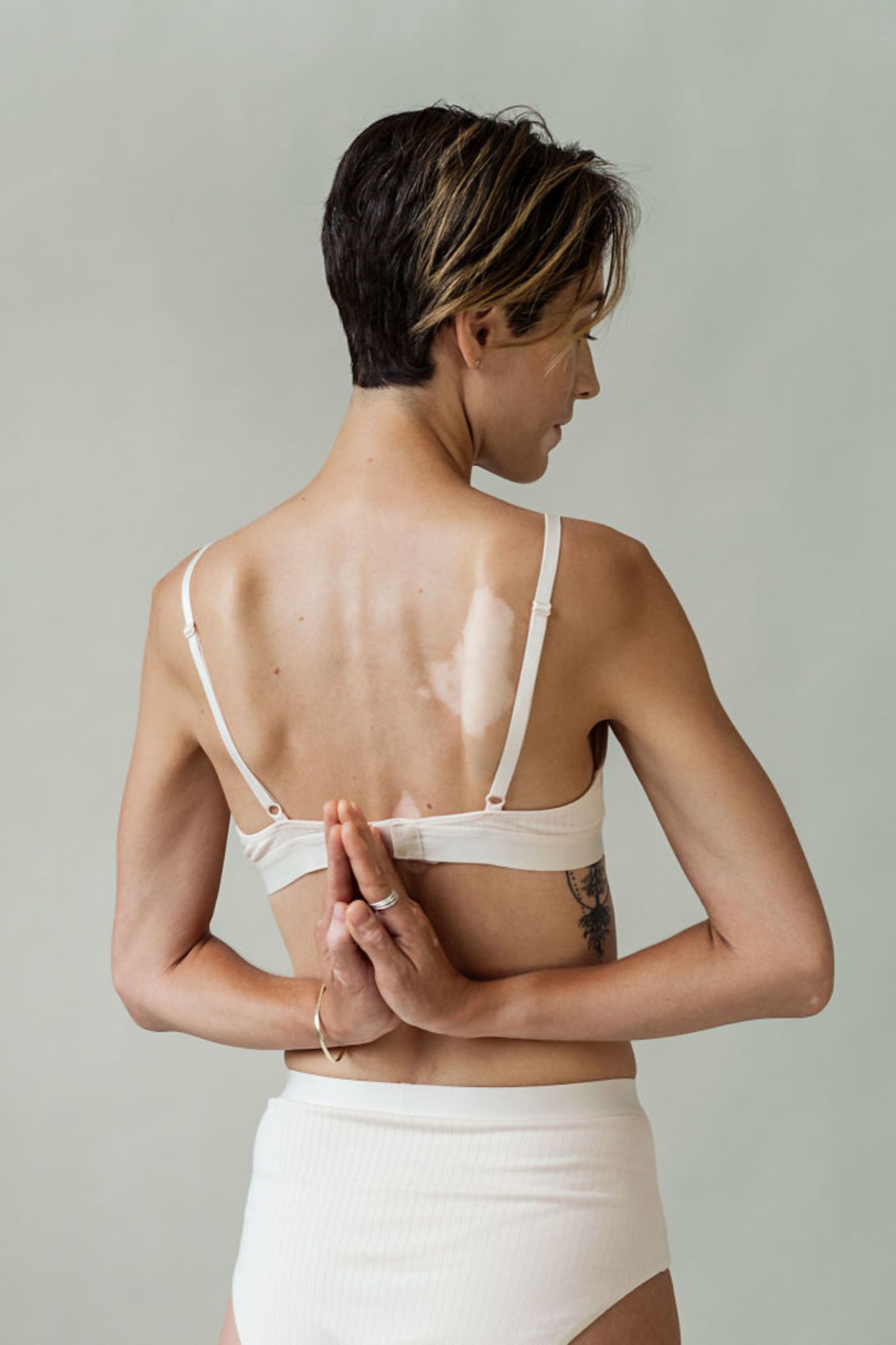 Einzigartig! Diese Fotos feiern die Schönheit von Frauen mit Vitiligo