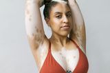 Einzigartig! Diese Fotos feiern die Schönheit von Frauen mit Vitiligo