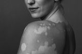 Einzigartig! Diese Fotos feiern die Schönheit von Frauen mit Vitiligo