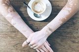 Einzigartig! Diese Fotos feiern die Schönheit von Frauen mit Vitiligo