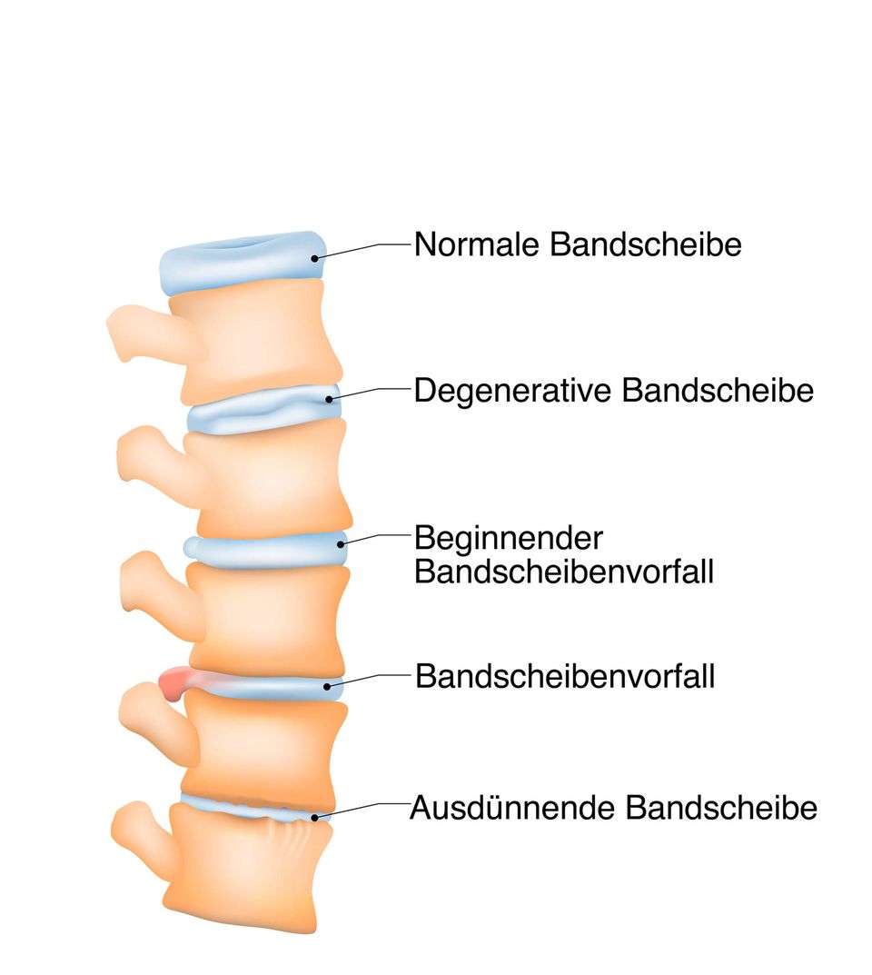 Bandscheibenvorfall: Grafik eines Bandscheibenvorfalls