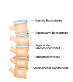 Bandscheibenvorfall Symptome und Behandlung BRIGITTE.de