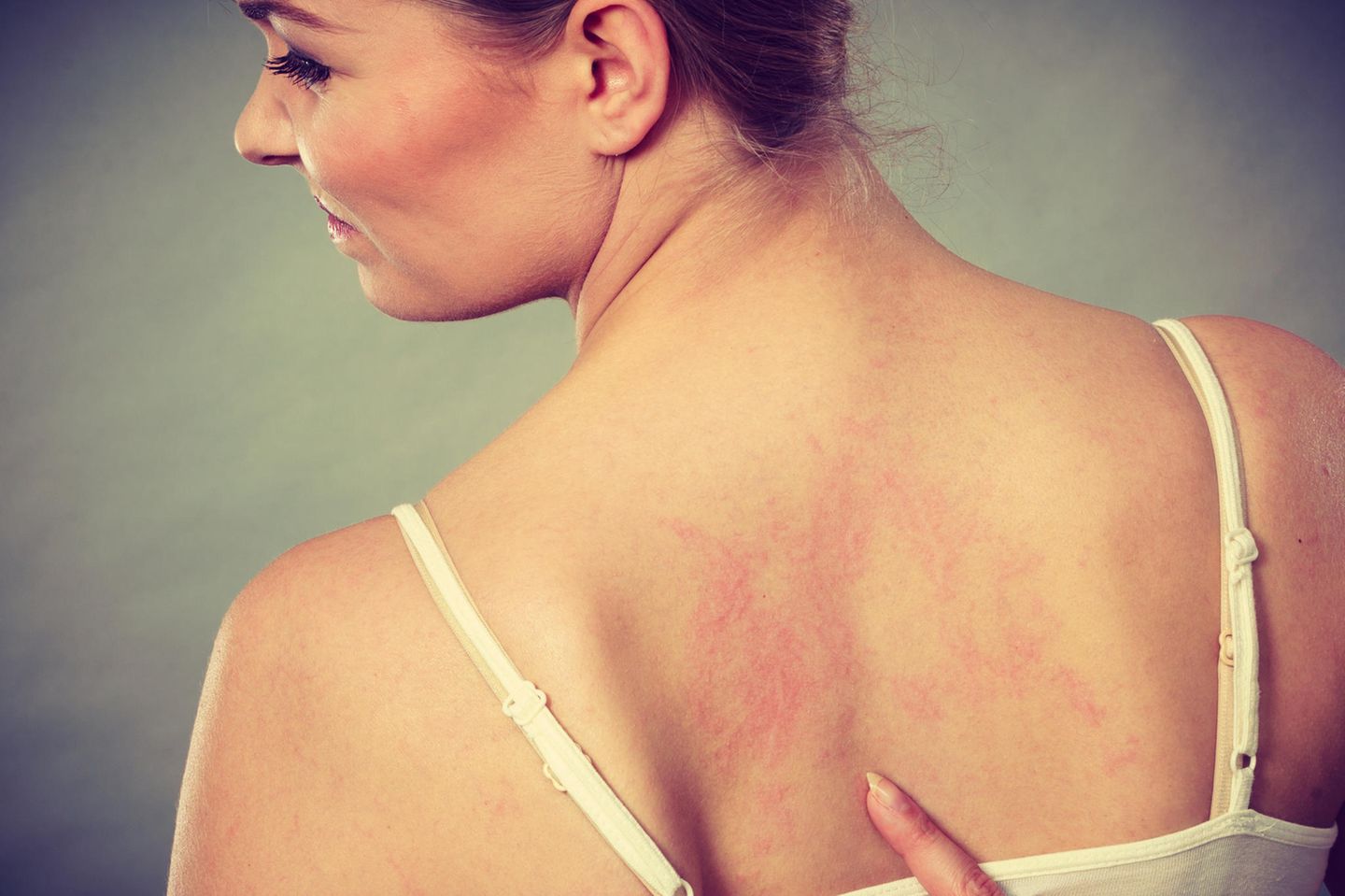 Hautproblem: Frau mit geröteter Haut
