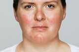 Hautbild verbessern: Hilfe gegen Akne, Falten und Co.: Rosazea vorher