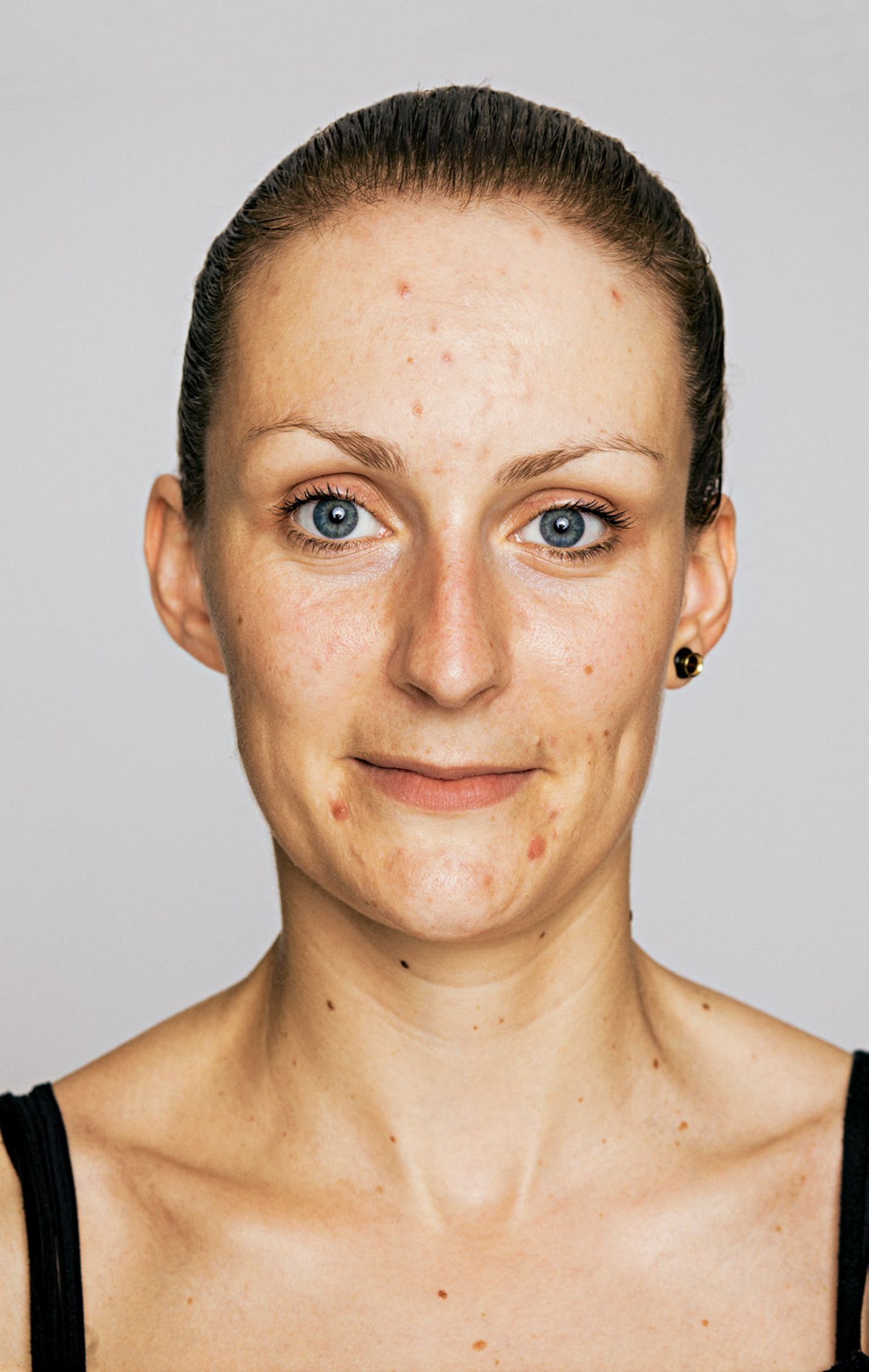 Hautbild verbessern: Hilfe gegen Akne, Falten und Co.: Spätakne vorher